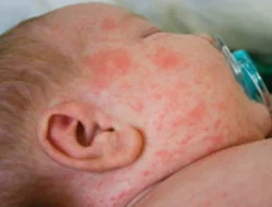 Jelang Lebaran 2026, Kasus Suspek Campak Merebak di Balikpapan dan Kukar