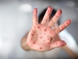 Kasus Suspek Campak Hampir Merata di Seluruh Daerah di Kaltim, Berikut Data selama Sepekan Terakhir